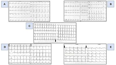 Case report: Acute toxic myocardial damage caused by 5-fluorouracil—from enigma to success